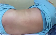 Hậu COVID-19: Bé 10 tuổi sốt cao, ho khan, nổi ban đỏ khắp cơ thể