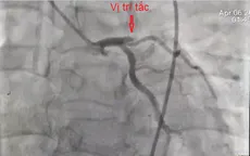 Người đàn ông ngừng tim ngoại viện do nhồi máu cơ tim cấp