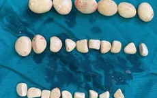 Phẫu thuật lấy hàng chục viên sỏi trong bàng quang bệnh nhân