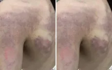Tạm dừng đứng lớp với cô giáo đánh học sinh lớp 3 bầm tím lưng