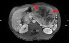 GIST dạ dày - Căn bệnh lành tính để muộn thành ung thư