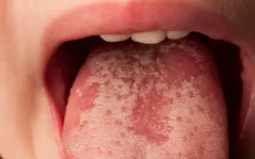 Đốm trắng trên lưỡi có thể là dấu hiệu của những điều này