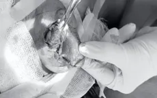 Nối thành công vành tại bị đứt lìa cho bệnh nhân