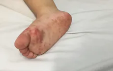 Bệnh tay chân miệng diễn biến phức tạp, có thể gia tăng thời gian tới