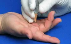 Ngón tay lò xo - sự khó chịu dai dẳng với người bệnh