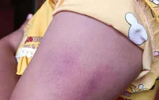 Học sinh lớp 1 bị cô giáo đánh tím tay vì không hoàn thành bài kiểm tra