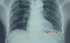 Dùng máy cắt cỏ cắt hàng rào kẽm gai bị dị vật dài 4cm xuyên vào buồng tim