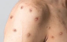 WHO cân nhắc ban bố tình trạng khẩn cấp đối với bệnh đậu mùa khỉ