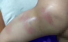 Xác minh vụ việc bé gái 4 tuổi nghi bị cô giáo đánh bầm tím