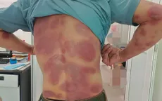 Dị ứng nặng do tự mua thuốc điều trị
