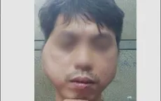 Nam thanh niên tố bị chủ quán lẩu nướng đánh đập biến dạng khuôn mặt