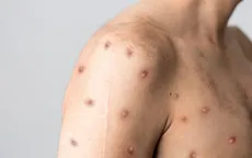 WHO khuyến nghị kiểm soát nguy cơ lây nhiễm bệnh đậu mùa khỉ