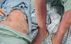 2 bệnh nhân bị viêm màng não, nhiễm khuẩn huyết do liên cầu lợn