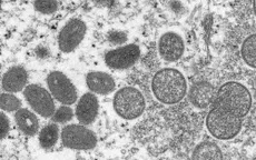 Cảnh báo virus đậu mùa khỉ có thể đã âm thầm lây lan