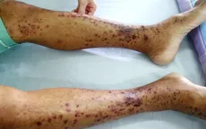 Điều trị thành công cho bệnh nhân bị ban xuất huyết Schonlein-Henoch