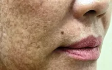 Sạm đen mặt vì lăn kim làm đẹp tại spa