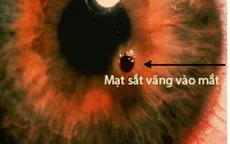 Gắp mảnh vụn sắt găm vào giác mạc bệnh nhân