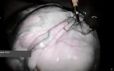 Phẫu thuật khối u nặng 10kg cho bệnh nhân nữ 62 tuổi