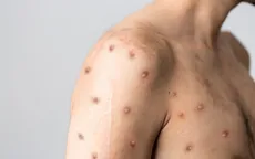 Mỹ ghi nhận trường hợp mắc COVID-19 và đậu mùa khỉ cùng lúc
