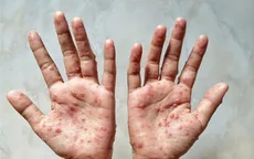 Triệu chứng, đường lây và cách phòng bệnh Đậu mùa khỉ