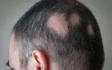Rụng tóc và rối loạn chức năng tình dục - triệu chứng COVID-19 kéo dài mới