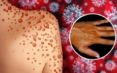 Triệu chứng bệnh đậu mùa khỉ trong đợt bùng phát mới khác so với trước đây