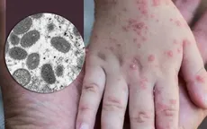 WHO báo cáo thêm 2 ca tử vong do đậu mùa khỉ, bệnh dịch lây lan sang các khu vực mới