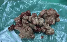 Cụ bà 81 tuổi phải cắt bỏ thận do sỏi san hô