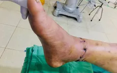 Bị máy cắt cỏ chém gần đứt lìa chân