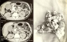 Phẫu thuật lấy sỏi ống tụy kích thước lớn hiếm gặp cho bệnh nhân