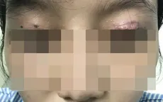 Bị tổn thương mắt vì thẩm mỹ chui