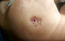 Hy hữu: Bệnh nhân bị... thủng má do biến chứng răng số 48 mọc lệch