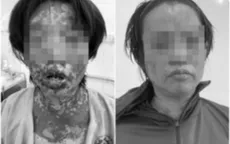 Người phụ nữ bị suy thận cấp, tổn thương da nặng do tự ý dùng thuốc