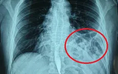 Tưởng hậu COVID-19, đi khám phát hiện bị vỡ cơ hoành