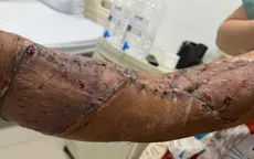 Tổn thương cánh tay nghiêm trọng do bị cánh quạt cuốn vào