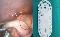 Ca bệnh hiếm gặp: Xương cá đâm thủng ruột thừa
