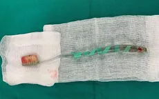 Nhập viện cấp cứu vì nuốt... bàn chải đánh răng