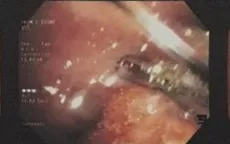 Đi khám vì đột ngột ho ra máu, nam thanh niên phát hiện u ác tính hiếm gặp