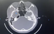 Biến chứng nội sọ do tai