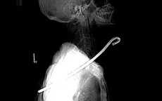 Cứu sống bệnh nhân bị cây sắt dài 30cm đâm thấu cổ