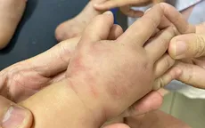 Trẻ sưng tím da giống bị bạo hành, vào viện khám phát hiện mắc ban xuất huyết Henoch - Schonlein