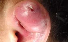 Cảnh báo áp xe vành tai sau bấm khuyên