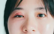 Tại sao lại xuất hiện “mụn” ở mắt?