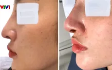 Nâng mũi, cô gái ở Vĩnh Long bị nhiễm trùng, lộ sống mũi