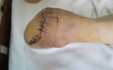 Cụ ông phải phẫu thuật tháo bỏ nửa bàn chân vì sự chủ quan