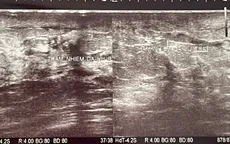 Sưng đau vùng cổ, đi khám phát hiện ung thư vú