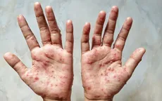 Phát hiện thêm 1 trường hợp mắc đậu mùa khỉ tại TP. Hồ Chí Minh