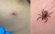 Sốt mò - Căn bệnh truyền nhiễm nguy hiểm dễ bỏ sót