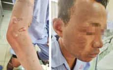 Người đàn ông bị bỏng nặng khi dùng xăng để đốt rác