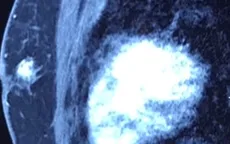 Cụ ông phát hiện mắc... ung thư vú sau khi sờ thấy khối u ở ngực